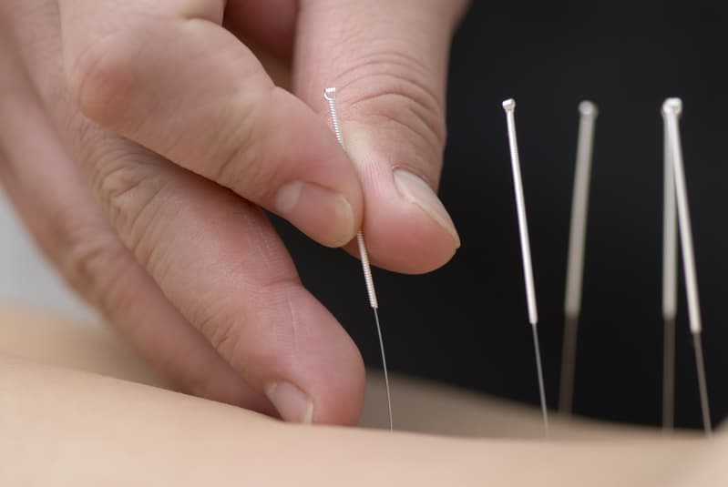 Acupuncture Background